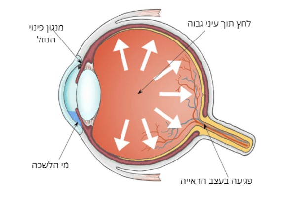 גלגל עין ובתוכו נוזל הגורם ללחץ גבוה.