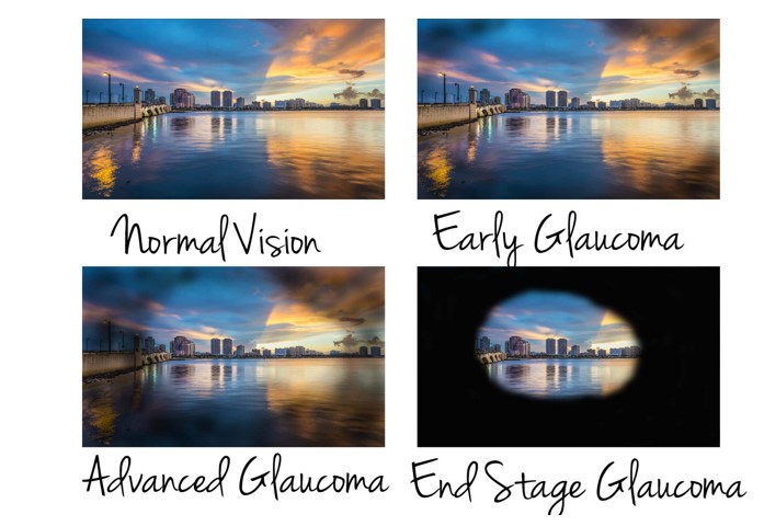 ארבע תמונות המתארות התפתחות גלאוקומה: תמונת נוף מצומצמת יותר בכל תמונה.